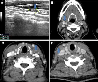 Frontiers | Lateral Lymph Node Metastases In T1a Papillary Thyroid ...